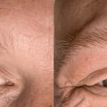 male-hairlossbrows-1